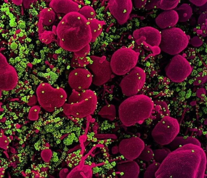  Archivo - Micrograf&iacute;a electr&oacute;nica de barrido coloreada de una c&eacute;lula apopt&oacute;tica (rosa) muy infectada con part&iacute;culas del virus SARS-COV-2 (verde), aislada de una muestra de un paciente. - NATIONAL INSTITUTE OF ALLERGY INFECTIOUS DISEASE 