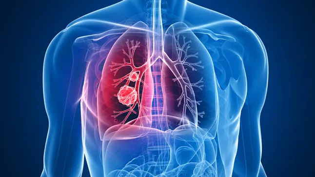  C&aacute;ncer de pulm&oacute;n. Twitter.. 