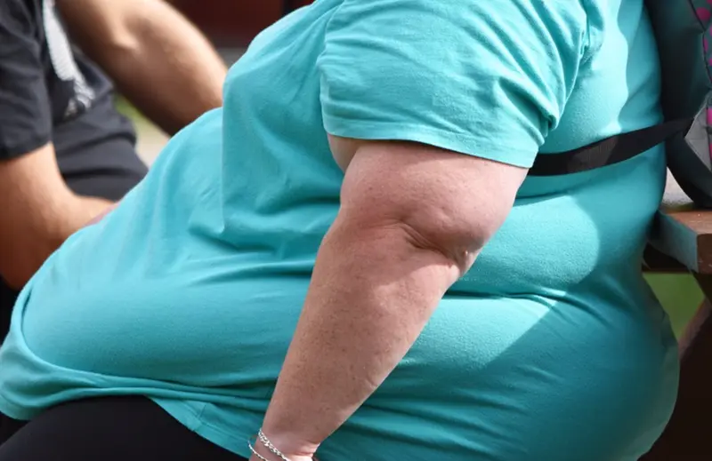 <p> Archivo - Persona con obesidad - HOSPITAL RUBER INTERNACIONAL - Archivo </p>