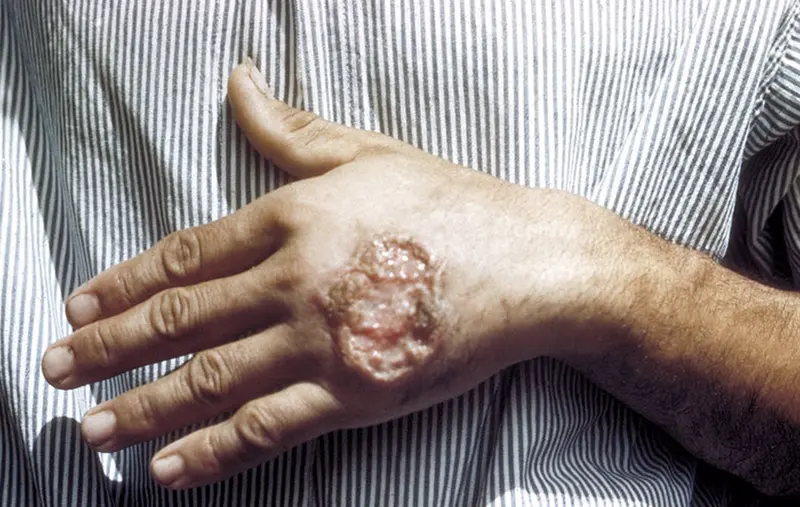 <p> Archivo - Leishmaniasis - CREATIVE COMMONS - Archivo </p>