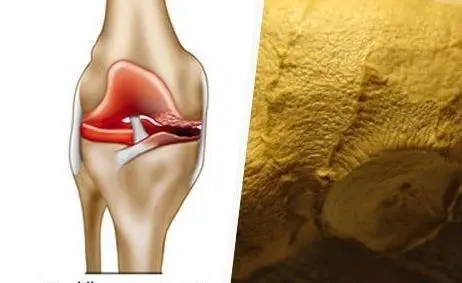 <p> rodilla con artrosis </p>