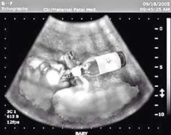 <p> ginec&oacute;logos advierten de los problemas del alcohol en el embarazo </p>