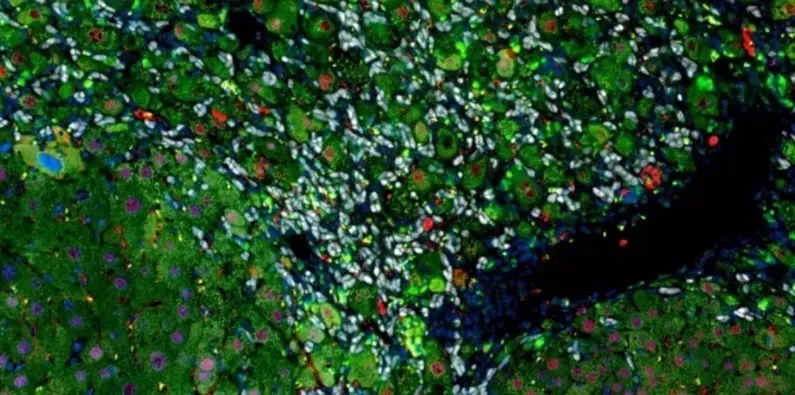 <p> La cirrosis hep&aacute;tica tiene un mecanismo que por fin se ha descubierto. </p>