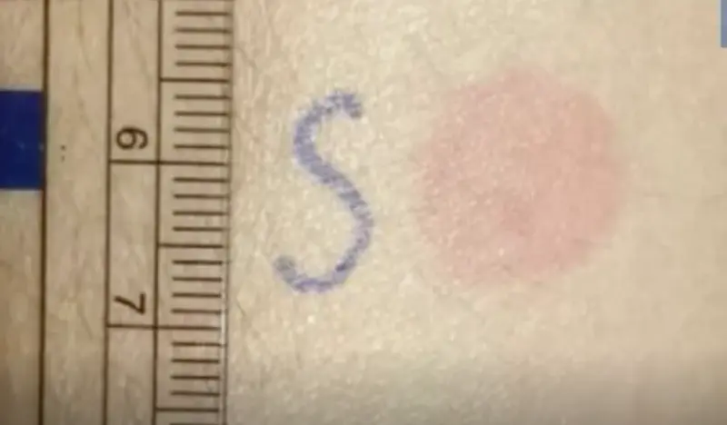 <p> Test cut&aacute;neo para dosis de refuerzo. Fuente: Twitter @YbpCph </p>