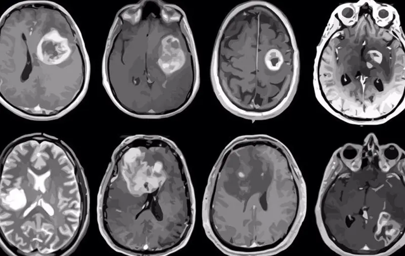 <p> Archivo - Glioblastoma, tumor cerebral agresivo mapeado en detalle gen&eacute;tico y molecular. - ALBERT H. KIM - Archivo </p>