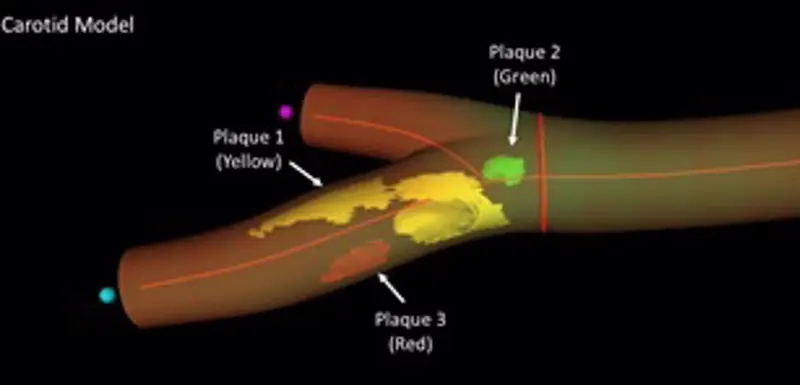 <p> Modelo 3D de la arteria femoral derecha que se obtiene con la imagen 3D real donde se representa la localizaci&oacute;n, n&uacute;mero y extensi&oacute;n de las distintas placas de aterosclerosis, hasta 3 placas en el caso de este paciente (flechas). - CNIC </p>