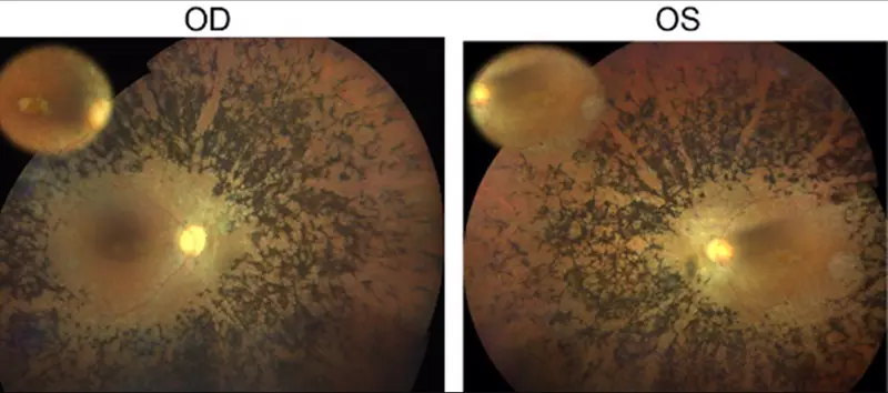 <p> Fondo de ojo del paciente con retinitis pigmentosa en el que se ha identificado la mutaci&oacute;n en el gen CFAP20. OD=ojo derecho, OS=ojo izquierdo. Fuente: Europa Press </p>