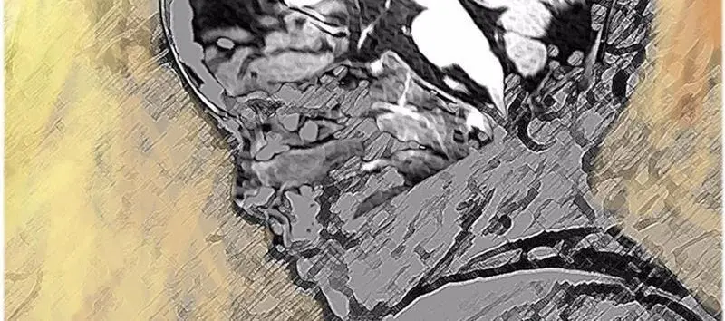 05/04/2022 Paciente con leucodistrofia.
ESPA&radic;&euml;A EUROPA MADRID SALUD
NATHALIE LAUNAY.
