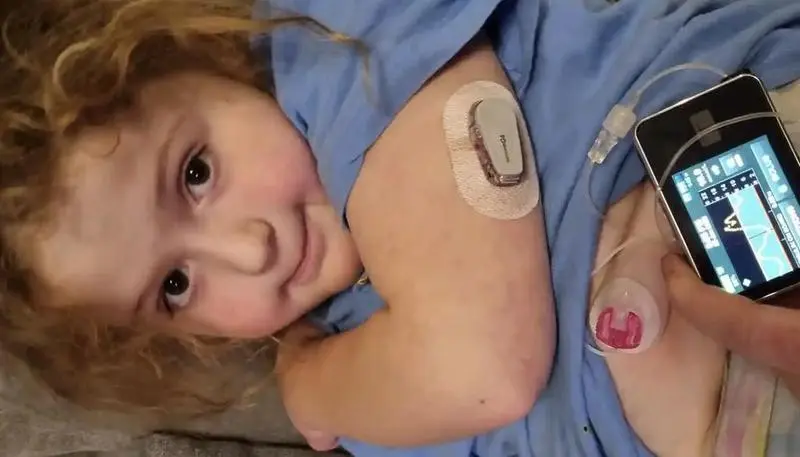 <p> Charlotte Abbott-Pierce con su p&aacute;ncreas artificial - NHS </p>