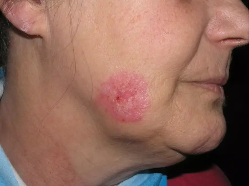 <p> El diagn&oacute;stico del lupus y su seguimiento, claves para la calidad de vida de los pacientes afectados por la enfermedad. Fuente: Europa Press </p>