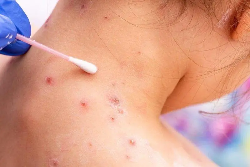 <p> Mujer con Viruela del Mono </p>