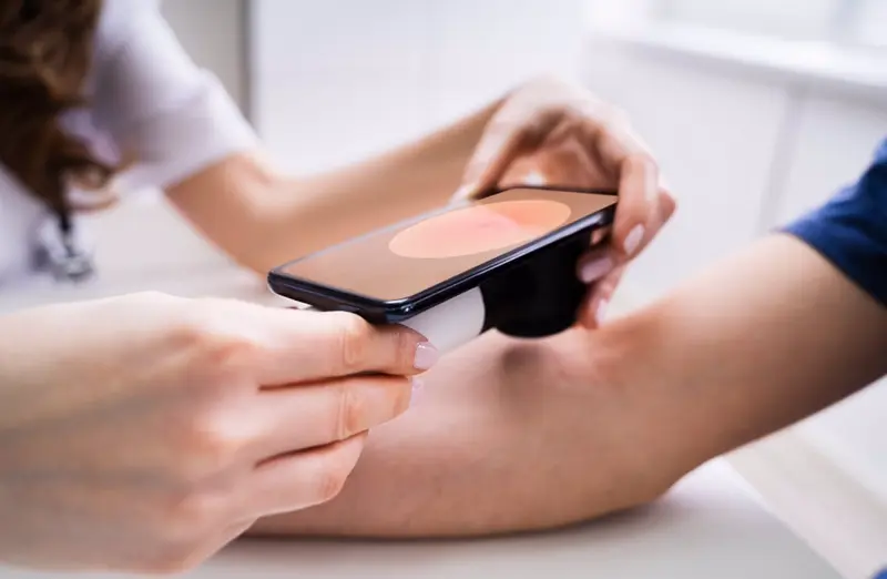 <p> Archivo - Las aplicaciones disponibles actualmente en el mercado no proporcionan medios para detectar nuevos lunares ni cambios en los ya existentes a lo largo del tiempo. - DALEM - Archivo </p>