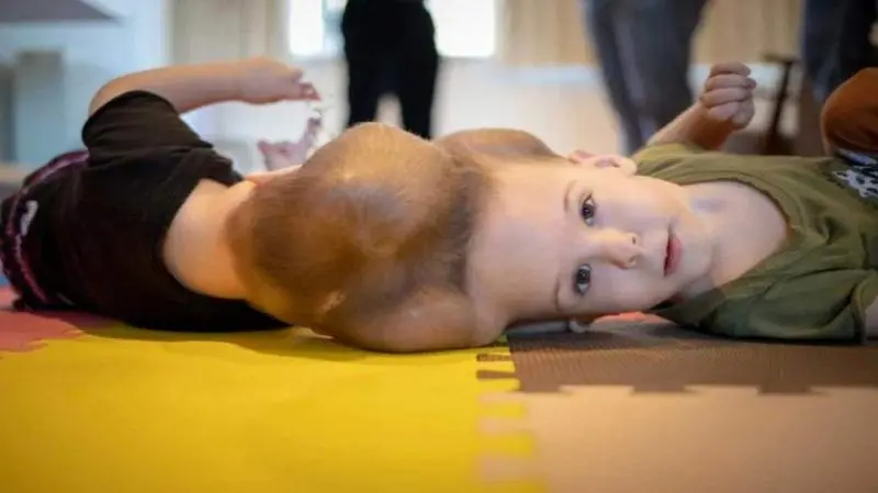 <p> Los hermanos Bernardo y Arthur Lima, siameses brasile&ntilde;os unidos por la cabeza han sido separados con &eacute;xito. Instituto Estatal del cerebro Paulo Niemeyer. </p>