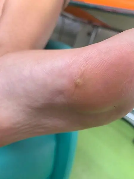 <p> Marca en el pie de la joven </p>