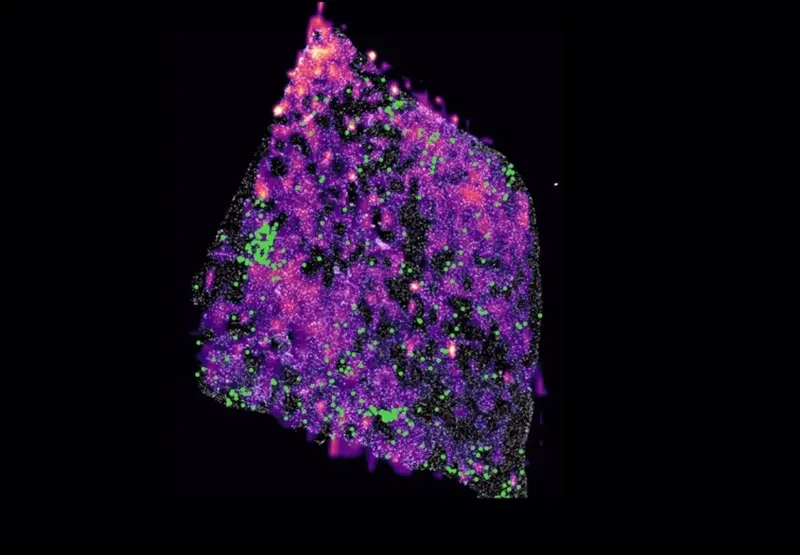 <p> Tumor de glioma humano con una mutaci&oacute;n que muestra grupos de c&eacute;lulas T en verde y cuyos puntos rosa representan concentraciones del metabolito D-2HG. - HARVARD MEDICAL SCHOOL - URV </p>