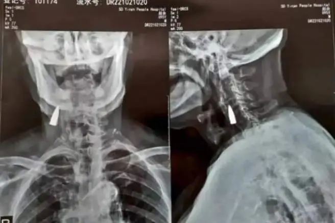  La radiograf&iacute;a del anciano chino de 95 a&ntilde;os con la bala en su cuello 