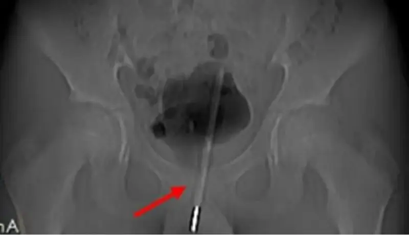  El term&oacute;metro atascado dentro del ni&ntilde;o 