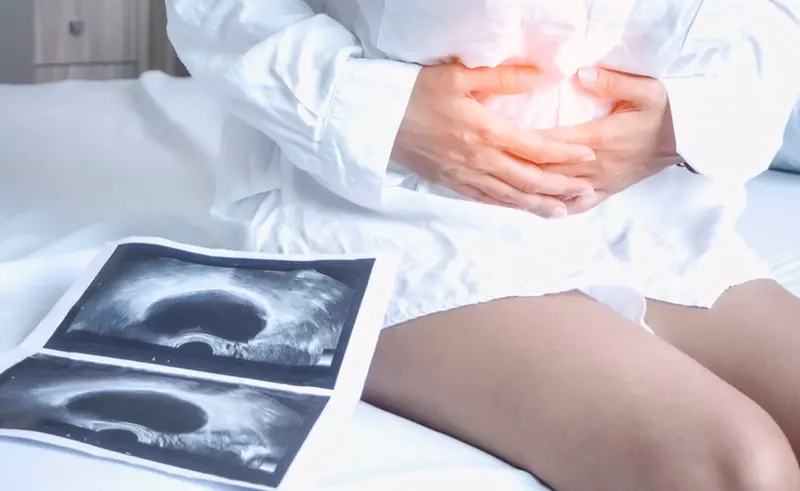  Archivo - S&iacute;ndrome de ovario poliqu&iacute;stico - CL&Iacute;NICA MARGEN - Archivo 