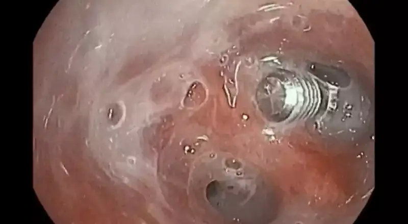  Tornillo en bronquios - Foto del Hospital Vithas 