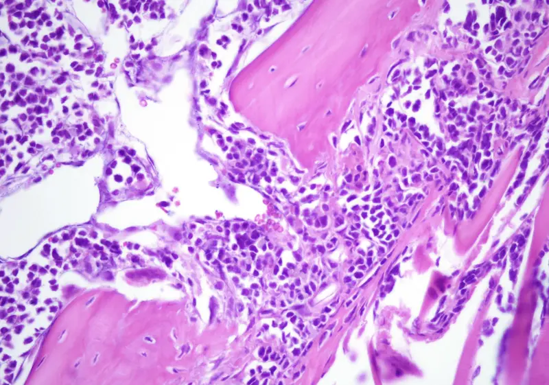  Archivo - Lesi&oacute;n Litica del modelo de Mieloma M&uacute;ltiple/ CSIC - CSIC - Archivo 