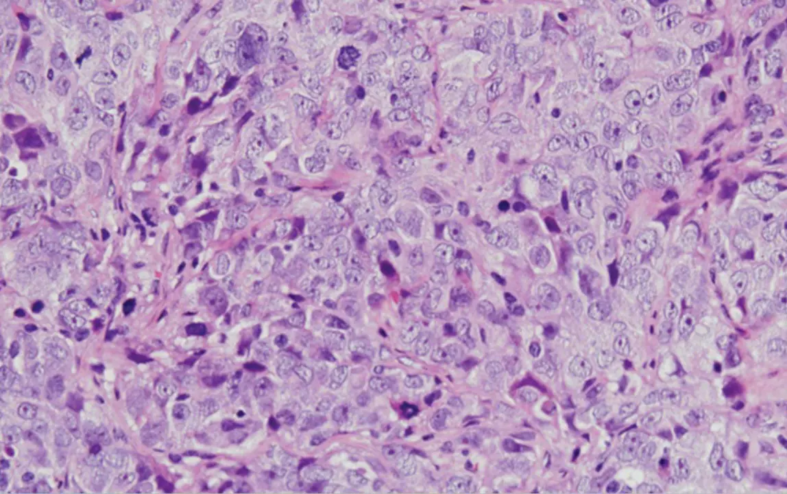  C&aacute;ncer de ovario seroso de alto grado - CSIC 