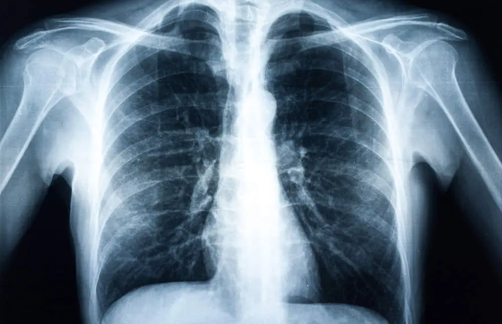  Xray of a human torax isolated 