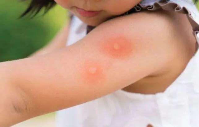  Picaduras de mosquitos. Pinterest. 