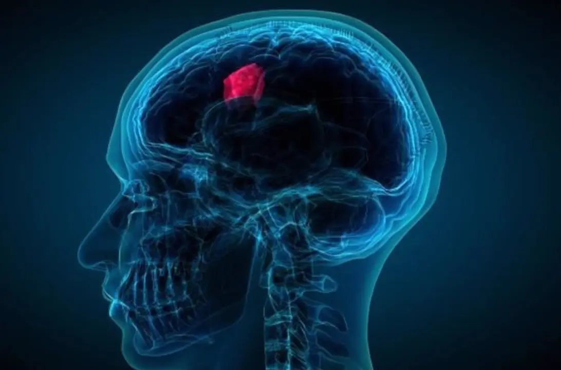  Archivo - Glioblastoma. - PENN MEDICINE - Archivo 