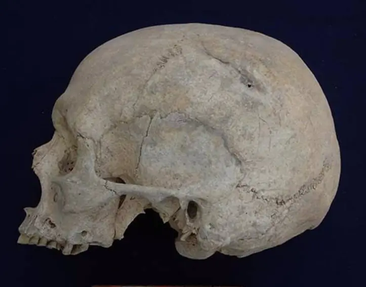  Cr&aacute;neo con fracturas 