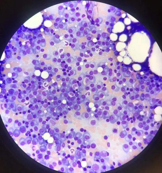 07-09-2021 Mieloma m&radic;&int;ltiple.
SALUD 
MD ANDERSON CANCER CENTER MADRID
