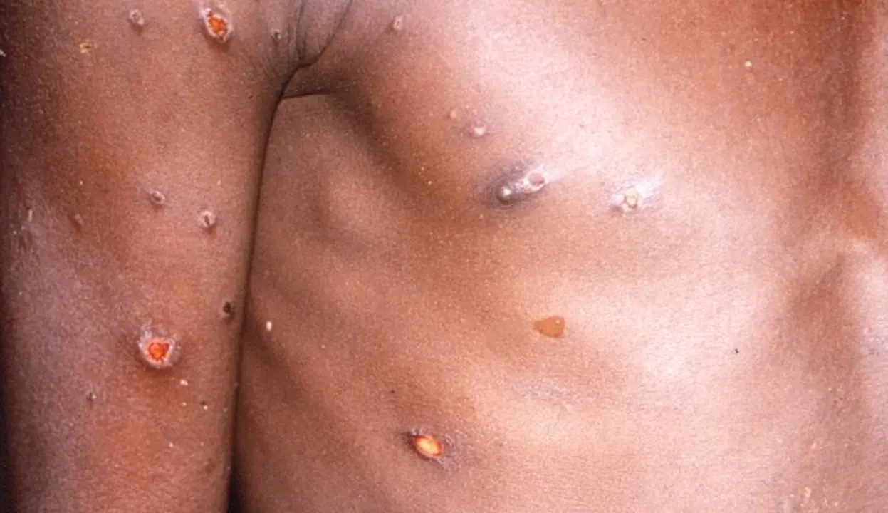  Archivo - La viruela del mono produce lesiones cut&aacute;neas, fiebre y dolor corporal en las personas afectadas por el virus. - CDC - Archivo 