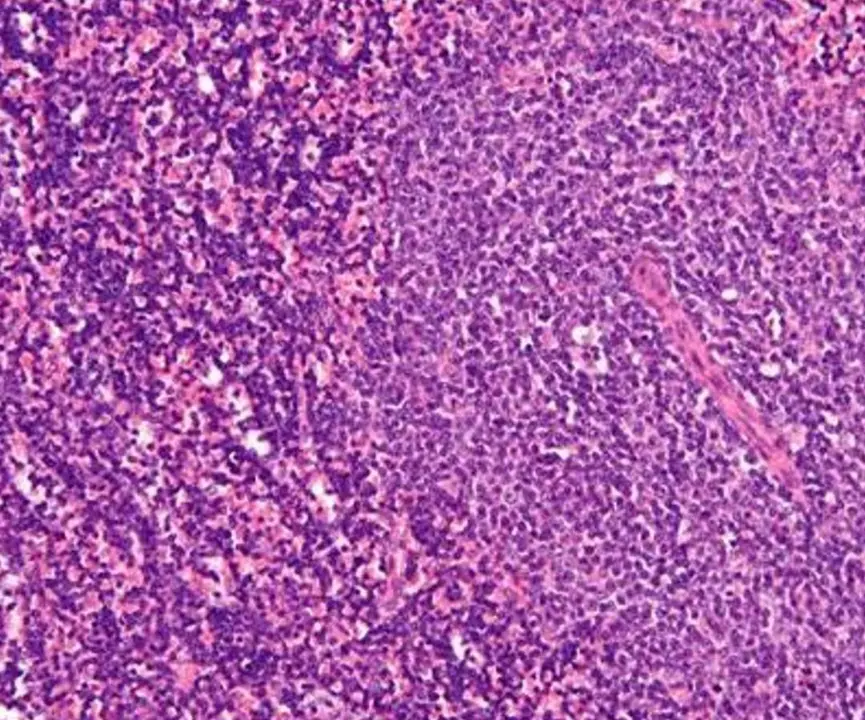  Leucemia linfoc&iacute;tica cr&oacute;nica 