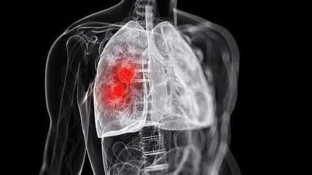  Pulm&oacute;n. ARCHIVO 