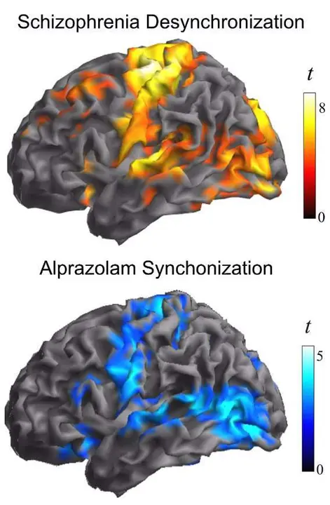  Imagen que muestra la similitud entre las &aacute;reas afectadas en el cerebro de una persona con esquizofrenia (figura superior) y las &aacute;reas donde se concentran las neuronas estudiadas (figura inferior) - HOSPITAL DEL MAR 