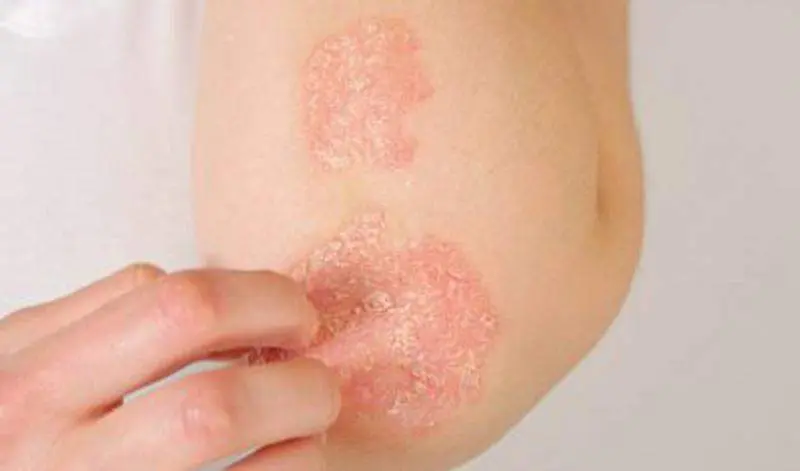  Dermat&oacute;logos andaluces publican un manual digital de casos cl&iacute;nicos de psoriasis 