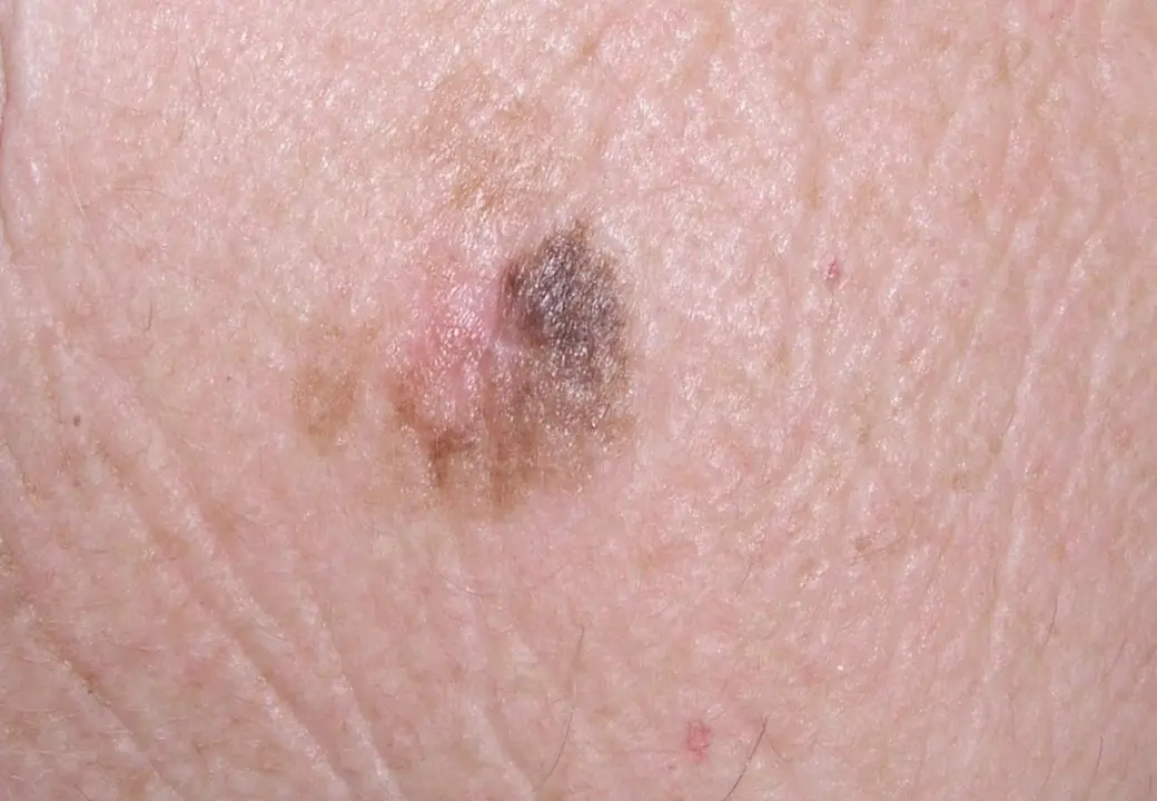  Archivo - Melanoma - EUROPEAN ASSOCIATION OF DERMATO 