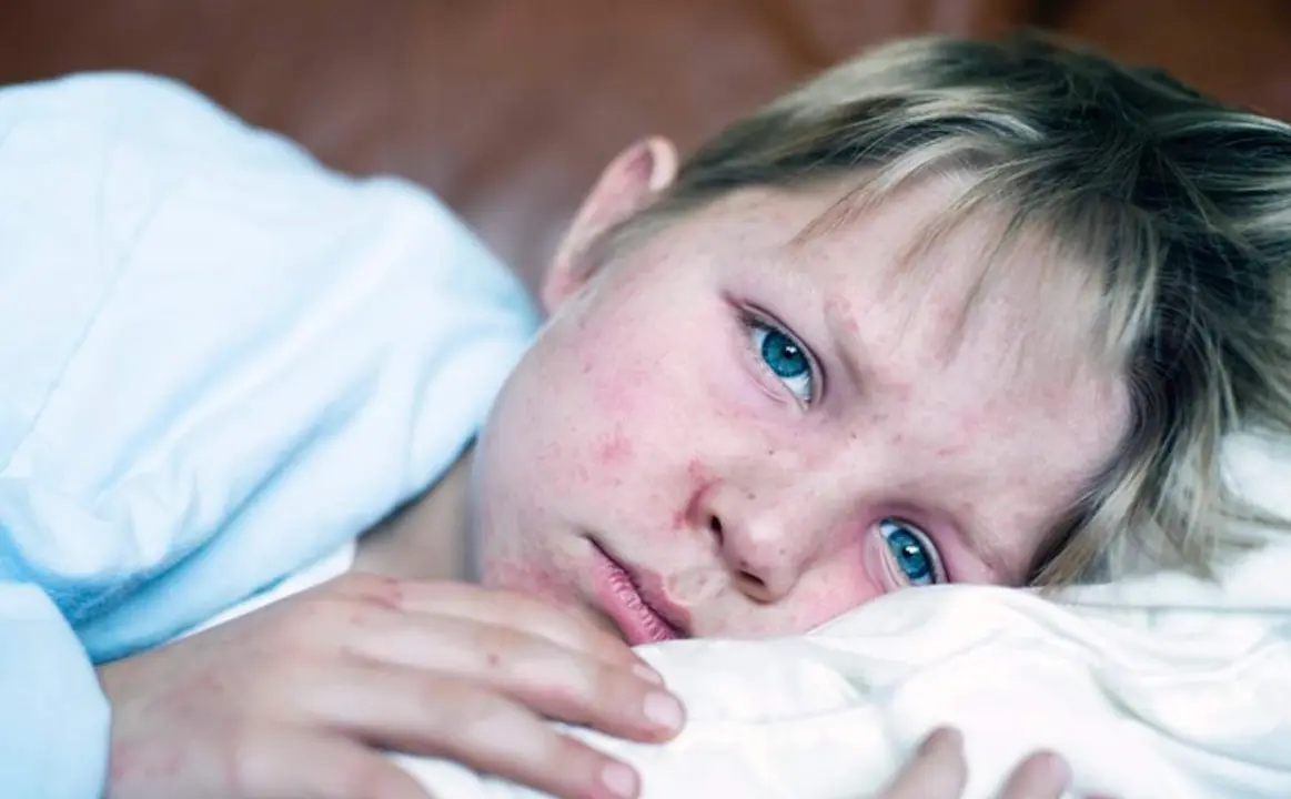  Archivo - Sarampi&oacute;n. - CHRISTOPHER BADZIOCH / CHBD - Archivo 