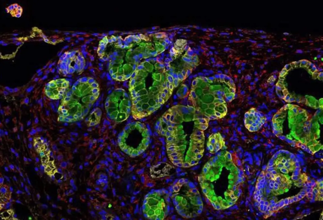  Inmunofluorescencia de un tumor de p&aacute;ncreas; la prote&iacute;na PGLYRP1 en verde. - BRUNO SAINZ (IIBM-CSIC-UAM) 