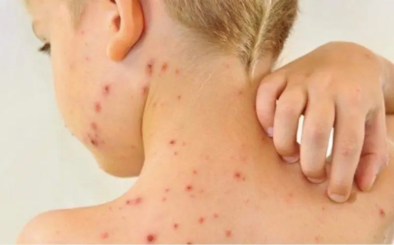  Ni&ntilde;o con sarampi&oacute;n. Imagen: Milenio.com 