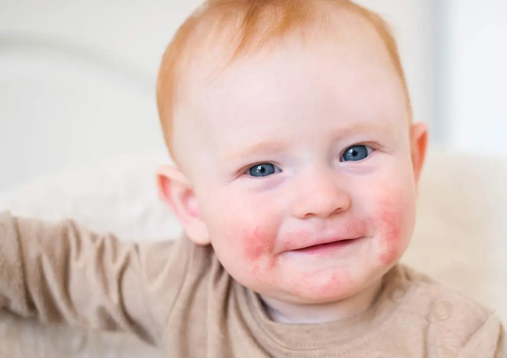  Dermatitis at&oacute;pica 