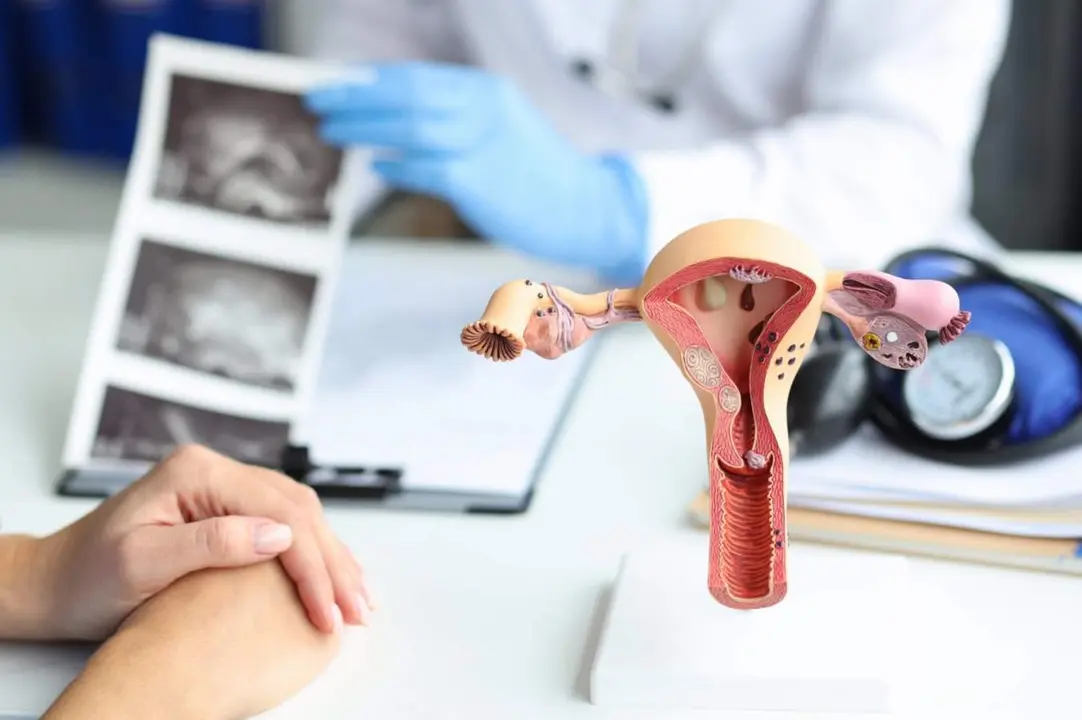  Archivo - C&aacute;ncer ginecol&oacute;gico. C&aacute;ncer de &uacute;tero - ASACO - Archivo 