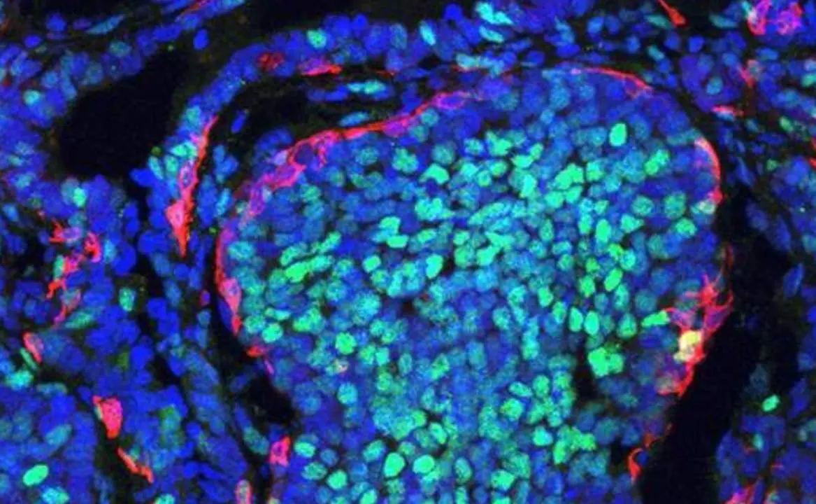  Archivo - Imagen de un tumor de mama en rat&oacute;n que muestra la segregaci&oacute;n de ambas poblaciones celulares - IN-CSIC-UMH - Archivo 