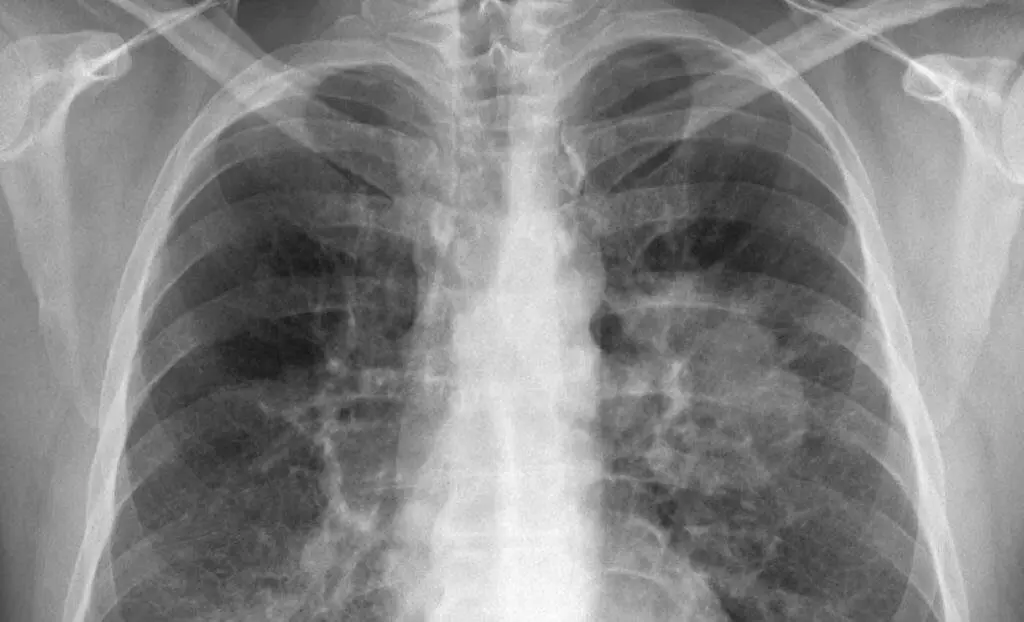  Radiograf&iacute;a de un c&aacute;ncer de pulm&oacute;n 