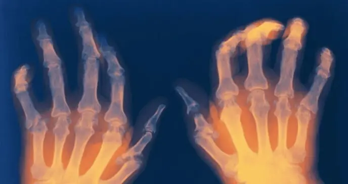  Reumat&oacute;loga resalta avances en artritis reum&aacute;tica y menor mortalidad 