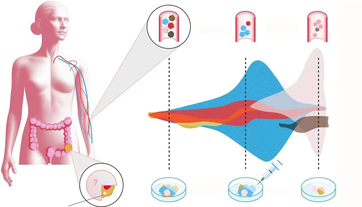  Una investigaci&oacute;n pionera mejora la detecci&oacute;n de micromet&aacute;stasis del c&aacute;ncer de colon mediante un an&aacute;lisis de sangre y abre las puertas a la inmunoterapia en fases tempranas 
