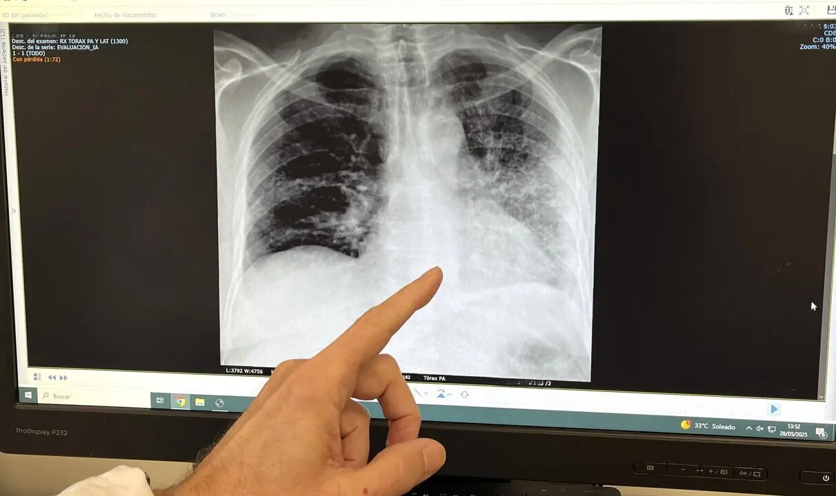  RX de paciente fumador con c&aacute;ncer de pulm&oacute;n 