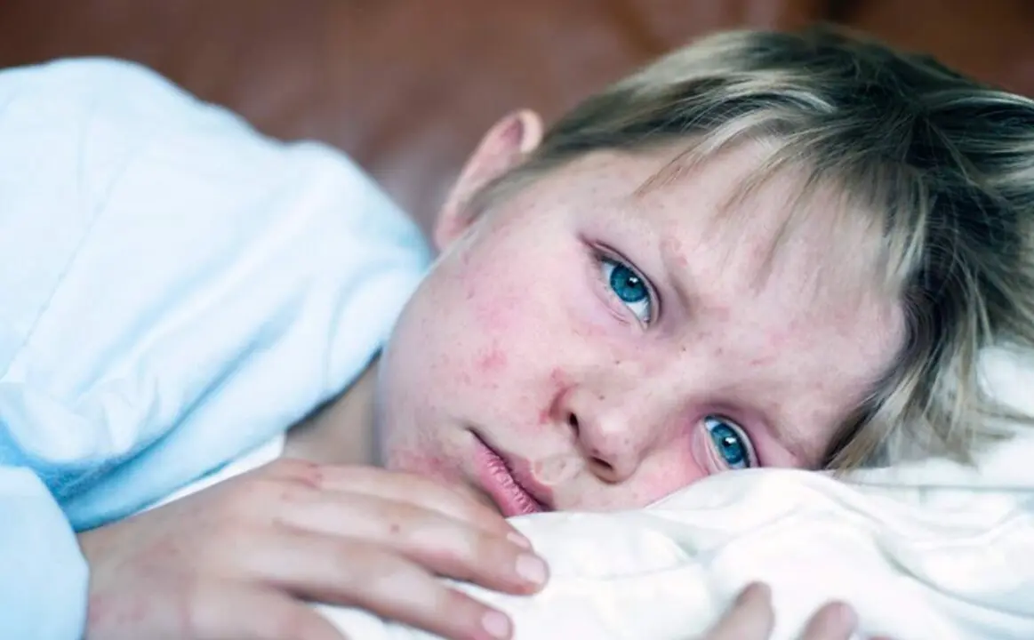  Archivo - Sarampi&oacute;n. - CHRISTOPHER BADZIOCH / CHBD - Archivo 