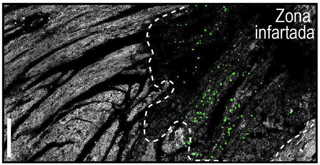 
<p>(Rogamos anulen esta noticia enviada por nuestro servicio de hoy ya que est&aacute; embargada hasta el viernes 12 a las 17.00 horas)</p>
<p>    MADRID, 10 (EUROPA PRESS)</p>
<p>   Un equipo de cient&iacute;ficos del Centro Nacional de Investigaciones Cardiovasculares (CNIC) ha logrado explicar porqu&eacute; los infartos que se producen en la noche son menos severos que los diurnos, y tiene que ver con la variaci&oacute;n a lo largo del d&iacute;a de la agresividad de los neutr&oacute;filos, un tipo de gl&oacute;bulo blanco.</p>
<p>   El trabajo, publicado en la revista 'Journal of Experimental Medicine', muestra la existencia de un mecanismo circadiano dentro de los neutr&oacute;filos que hace fluctuar su actividad destructiva, y determina el grado de da&ntilde;o que provocan en el coraz&oacute;n tras un infarto.</p>
<p>   Debido a que los seres humanos son una especie diurna, existe una mayor probabilidad de exponerse a infecciones durante esta etapa del d&iacute;a, motivo por el que el sistema inmunol&oacute;gico ajusta sus picos de actividad al ritmo circadiano, aunque esta respuesta puede en ocasiones volverse perjudicial en casos de estr&eacute;s como los infartos de miocardio, en los que el sistema inmunitario puede causar da&ntilde;os colaterales severos en los tejidos.</p>
<p>   "Por la noche, los neutr&oacute;filos se dirigen a la zona da&ntilde;ada respetando el tejido sano, que as&iacute; no se ve afectado. Es durante el d&iacute;a cuando pierden esta direccionalidad y generan m&aacute;s da&ntilde;o en el tejido circundante", ha explicado la primera autora del estudio, la doctora Alejandra Aroca-Crevill&eacute;n.</p>
<p>   Durante la investigaci&oacute;n tambi&eacute;n se ha desarrollado una estrategia farmacol&oacute;gica en modelos experimentales para bloquear este reloj molecular, lo que permite mantenerlas en un "estado nocturno" y reducir su potencial da&ntilde;ino durante el infarto.</p>
<p>   "Nos sorprendi&oacute; comprobar (...) que el bloqueo del reloj circadiano de los neutr&oacute;filos no solo protege el coraz&oacute;n, sino que tambi&eacute;n mejora la respuesta frente a algunos microbios e incluso reduce las embolias asociadas a la anemia falciforme", ha a&ntilde;adido la primera autora de la investigaci&oacute;n.</p>
<p>   Por su parte, el jefe del grupo investigador, el doctor Andr&eacute;s Hidalgo, ha detallado que "el compuesto imita un factor que el cuerpo produce principalmente durante la noche", y que este factor "enga&ntilde;a" a los neutr&oacute;filos para hacerles creer que "es de noche", lo que disminuye su actividad t&oacute;xica.</p>
<p>   Su desarrollo se ha llevado a cabo en colaboraci&oacute;n con el l&iacute;der del grupo de Investigaci&oacute;n Cardiovascular Traslacional Multidisciplinaria en el (CNIC), el doctor H&eacute;ctor Bueno, tras analizar los datos de miles de pacientes del Hospital 12 de Octubre.</p>
<p>   Este trabajo constituye una de las primeras estrategias en aprovechar los ritmos circadianos del sistema inmunitario para modular la inflamaci&oacute;n, y sin comprometer la defensa frente a infecciones, lo que "abre la puerta" a nuevas terapias basadas en la biolog&iacute;a del tiempo, que tienen el potencial de proteger el coraz&oacute;n y otros &oacute;rganos del da&ntilde;o inflamatorio sin debilitar las defensas naturales del organismo.</p>
<p>   Adem&aacute;s, ha sido financiado por la Fundaci&oacute;n La Caixa; los Institutos Nacional de Salud de Estados Unidos; el Ministerio de Ciencia, Innovaci&oacute;n y Universidades (MICIU); el Consejo de Becas de China; la ANR PRC; la Fundaci&oacute;n para la Investigaci&oacute;n M&eacute;dica de Francia (FRM); la red transatl&aacute;ntica de excelencia Leducq sobre efectos circadianos en ictus; la Sociedad Espa&ntilde;ola de Cardiolog&iacute;a; y ha recibido el apoyo de AstraZeneca, Boehringer Ingelheim y Janssen.</p>
      