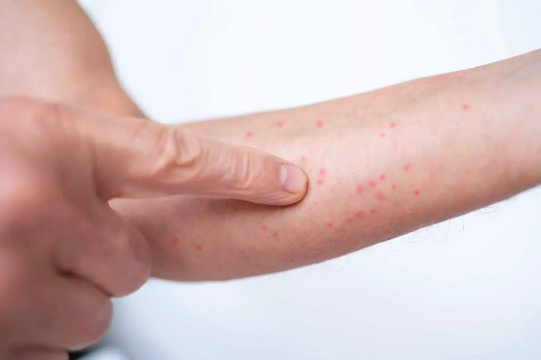 Inflamed skin with red spots on man's arm, symptoms conditions like chronic psoriasis, dermatitis or allergic response, topical medication