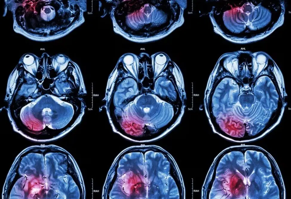 C&aacute;ncer cerebral